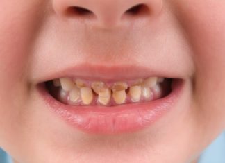 “Le bevande zuccherate rovinano i denti”: sì a immagini choc su bottiglie
