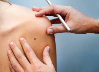 Sapete riconoscere se i vostri nei sono pericolosi? nei