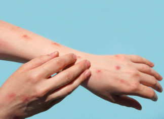 Vaiolo delle scimmie, su Nature le risposte a 4 domande chiave vaiolo delle scimmie