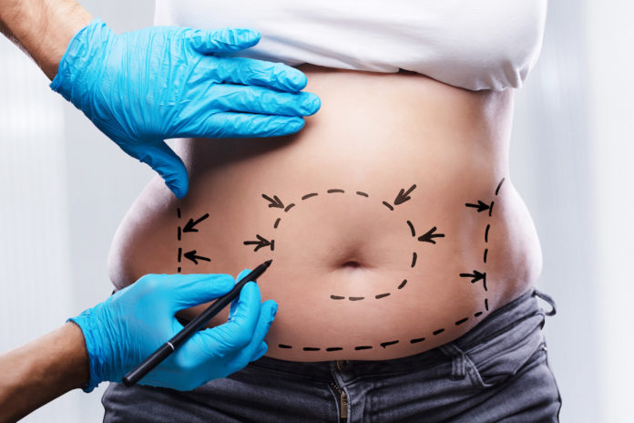 liposuzione liposuzione