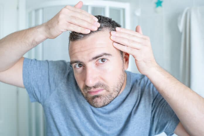 alopecia